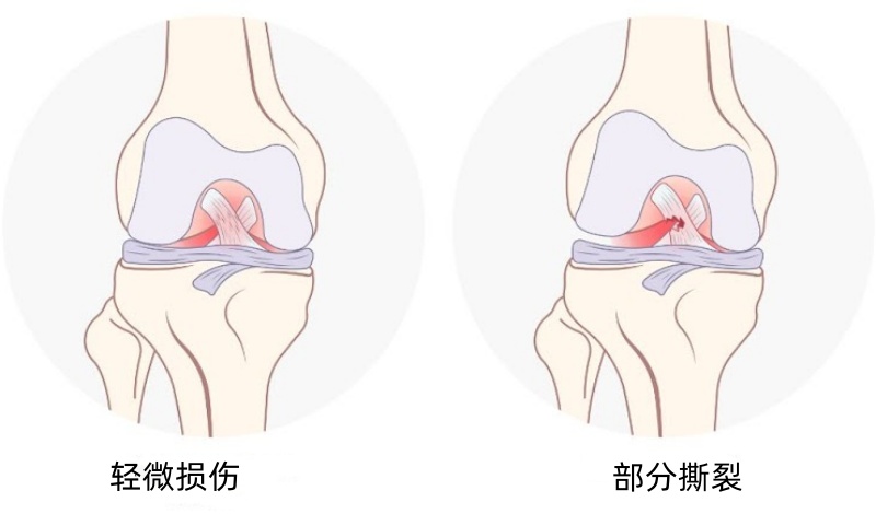 季后赛带伤作战！杰威接受右手韧带撕裂修复手术